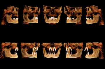 Компьютерная томография до и после имплантации все на четырех