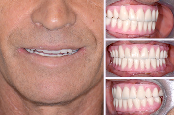 Прикус пациента до и после операции по зубной имплантации все на четырех в клинике Фэйс Смайл центр