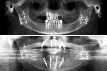 CT-Scan до и после имплантации зубов после травмы челюсть по методике все на четырех в клинике Фэйс Смайл центр