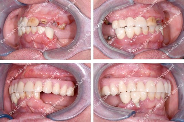 Пациент до и после операции по зубной имплантации верхней челюсти все на четырех в клинике Фэйс Смайл центр
