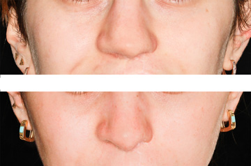 Ринопластика, коррекция формы носа при расщелине верхней губы и неба, выполнена в клинике Фэйс Смайл центр, фото до и после пластической операции в анфас