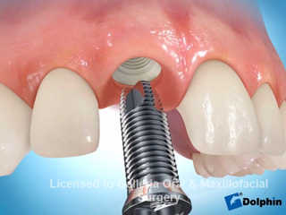 Имплант центрального зуба с подсадкой кости